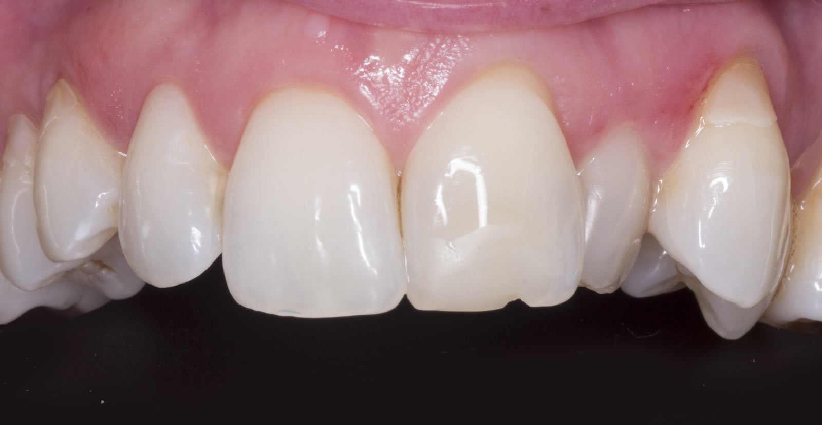 tooth whitening in donegal